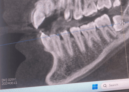 Impacted Wisdom tooth requiring treatment